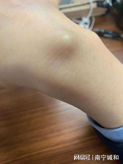宁城和医院讲腱鞘炎预防和保养球王会体育上班族必看！ 南(图2)
