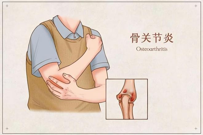 出现这些症状可能是关节炎在作怪！球王会且行且珍“膝”!老年人长期